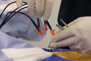 Beyond pills and surgery: how radiofrequency ablation is helping chronic pain sufferers
