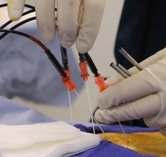 Beyond pills and surgery: how radiofrequency ablation is helping chronic pain sufferers